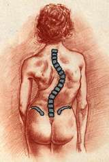 Figure 2 In a right thoracic scoliosis, the major scoliosis is concentrated in the thoracic (mid back) region and the spine curves to the right.